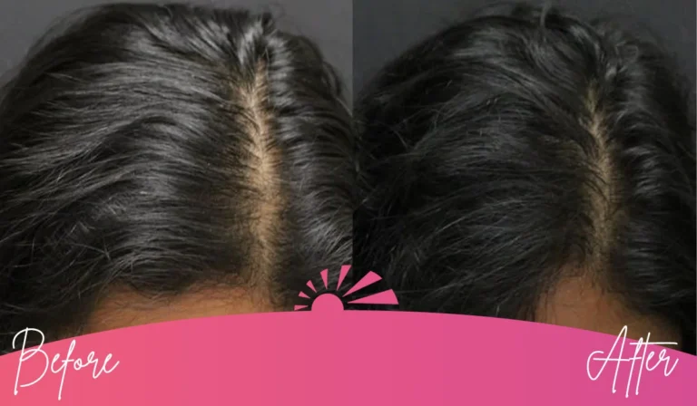 Hair Restoration Image 1