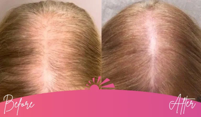 Hair Restoration Image 2