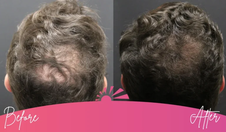 Hair Restoration Image 3