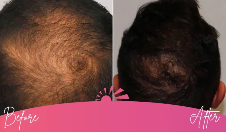 Hair Restoration Image 4